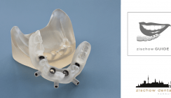 Sicher Implantieren mit zischow GUIDE®