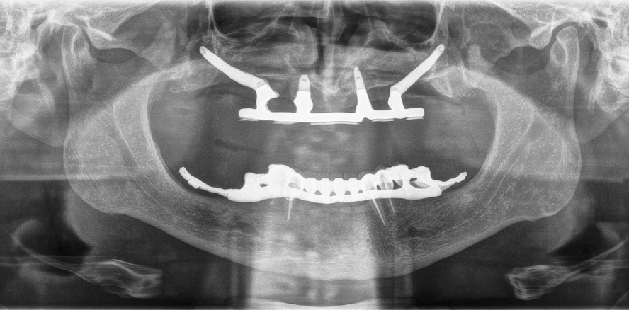 Zygoma Shorty All-on-4 nach totalem Knochenverlust im Oberkiefer