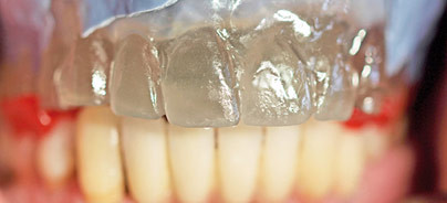 Abformung und Registrierung für ­implantatgetragenen Zahnersatz