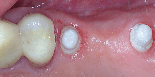 Sofortimplantation von ein- und zweiteiligen Keramikimplantaten