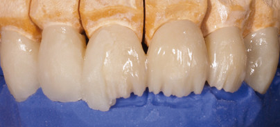 Selbstbewusst lächeln auch mit Provisorium