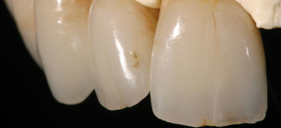 Gegenüberstellung: Vollkeramik vs. Metallkeramik