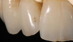 Gegenüberstellung: Vollkeramik vs. Metallkeramik