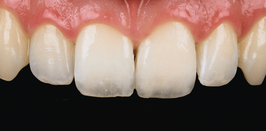 Minimalinvasive Keramikversorgung einer Kronenfraktur