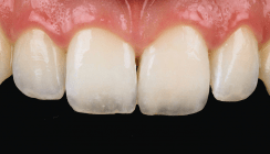 Minimalinvasive Keramikversorgung einer Kronenfraktur