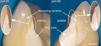 Belastbarkeit von Keramiken – Ursachen für Frakturverluste