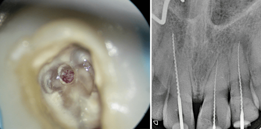 Die endodontische Zugangskavität