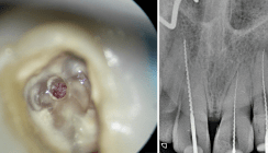Die endodontische Zugangskavität