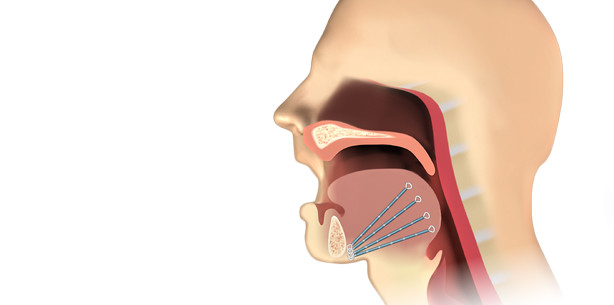 Zungenimplantat hilft bei Atemaussetzern und Rhonchopathie