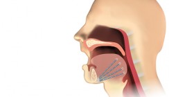 Zungenimplantat hilft bei Atemaussetzern und Rhonchopathie