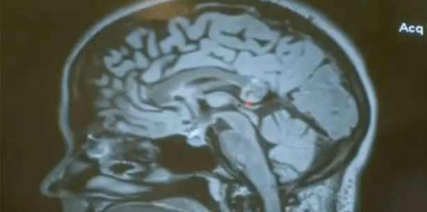 Skurriler Fund: Embryo mit Haaren und Zähnen im Kopf