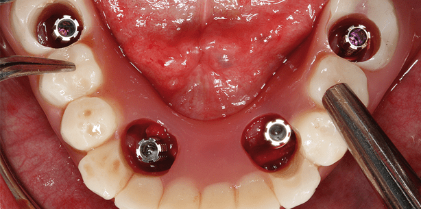 Sofortversorgung mit implantat-getragener Vollbogenrestauration