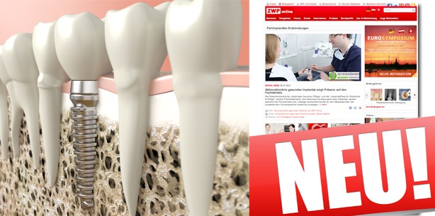 Periimplantitis – Von den Ursachen bis zur Therapie