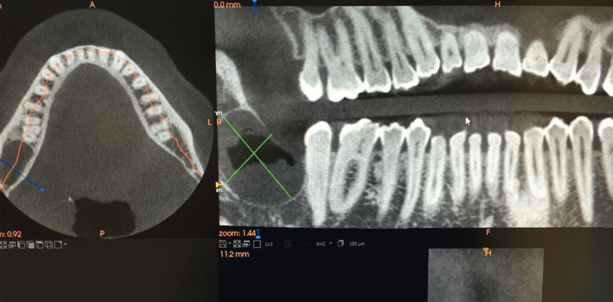 „Bei jeder retromolaren Schwellung sollten auch Zysten und Tumore in Betracht gezogen werden“