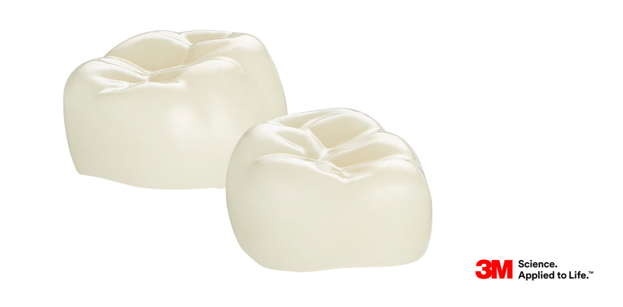 3M Ästhetische Kinderkrone: Die neueste Krönung auf Komposit-Basis