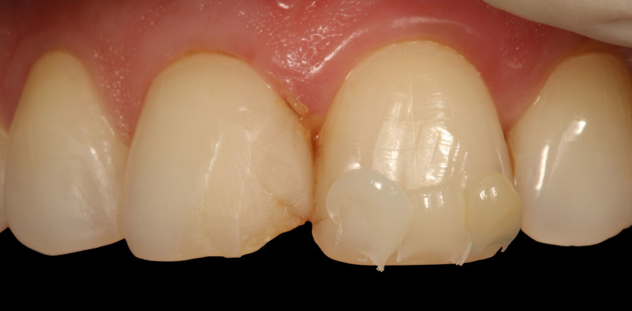 3M Filtek Easy Match: neues Universalkomposit im Praxistest