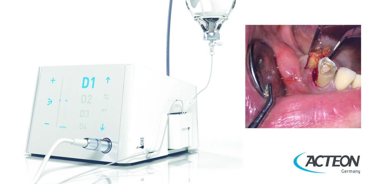Zahnextraktionen mit Ultraschall: Sicher und schnell