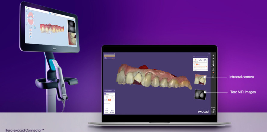 Align stellt die neueste Version des iTero – exocad Connector vor