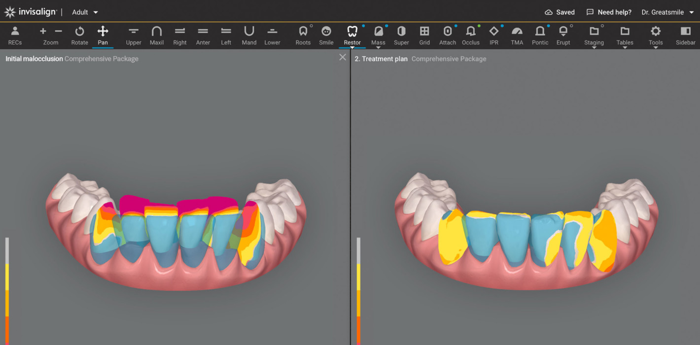 Dr. Bitar im Interview über die Invisalign Smile Architect Software