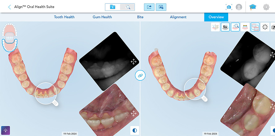 Align Technology kombiniert intraorale Scans und KI-gestützte Röntgenanalyse