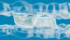 Align Technology kündigt die Verfügbarkeit eines neuen Invisalign® Systems an