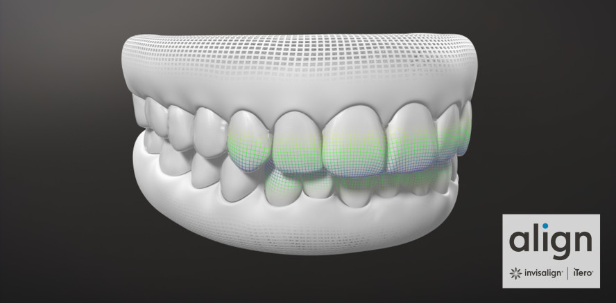 Das Invisalign G8 bietet neue SmartForce Aligner-Aktivierung