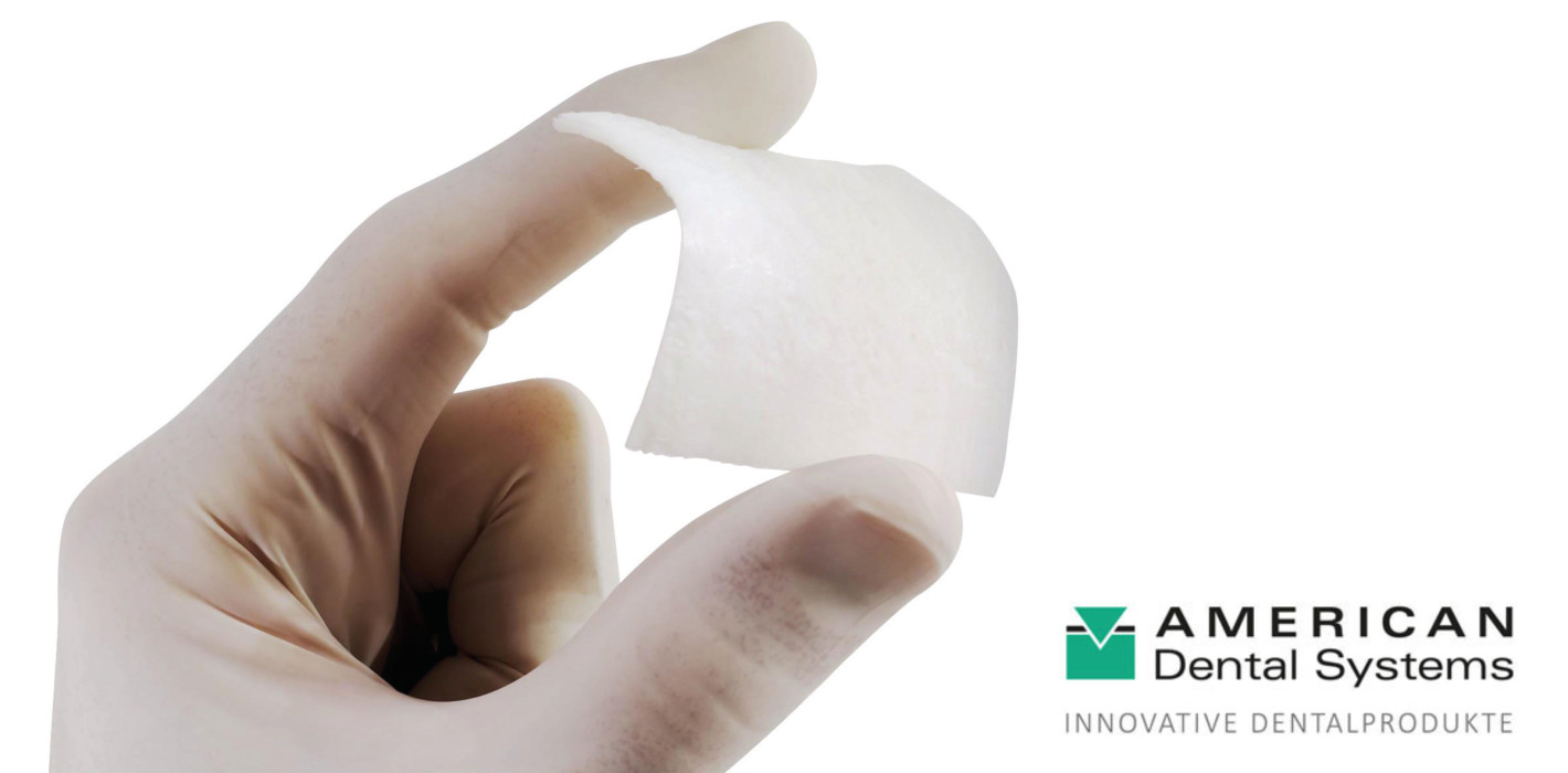 Xenogene Bone Lamina – das Multitalent für die Augmentation