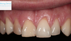 Freie Plätze beim Bösing Dental Teamkurs für Veneertechnik im November