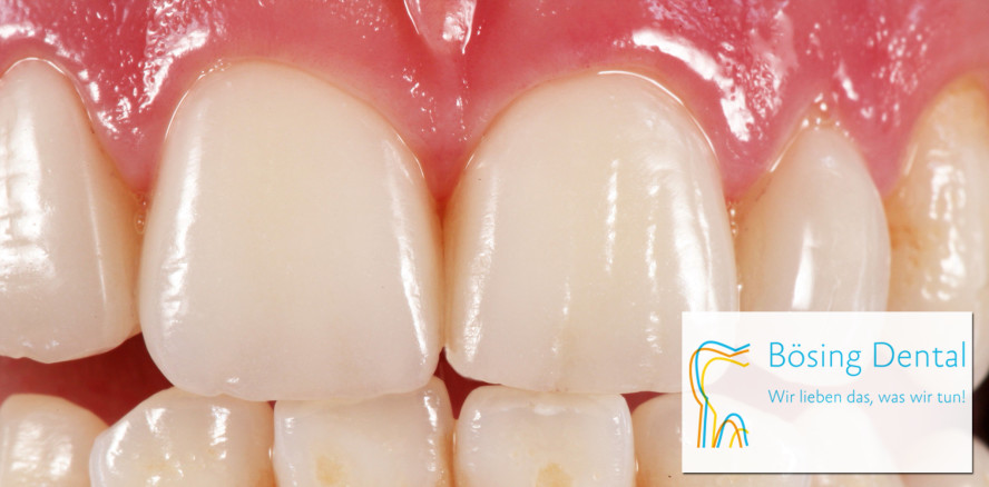 Bösing Dental: Teamkurs für die Veneertechnik im  November 2021