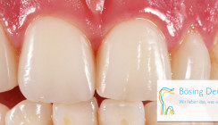 Bösing Dental: Teamkurs für die Veneertechnik im  November 2021