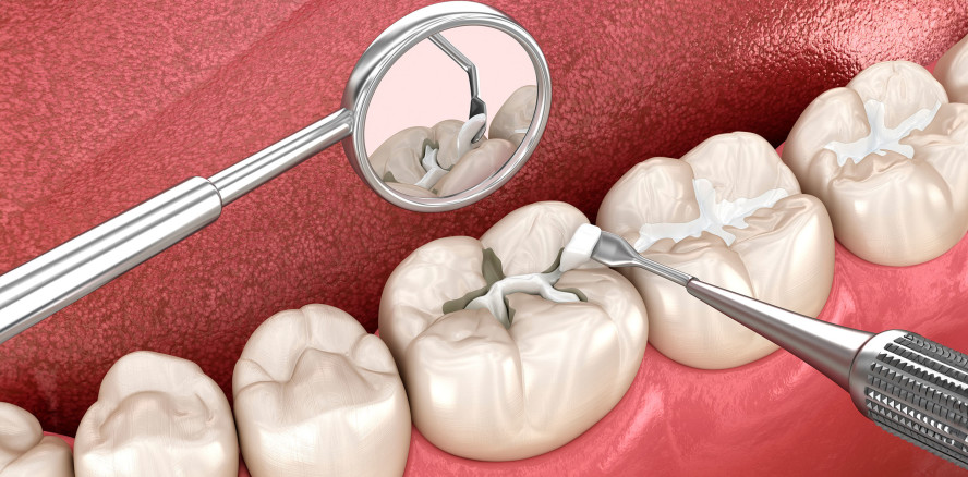 Ersatzmaterial für Füllungen wegen Amalgamverbots ab 1. Januar 2025