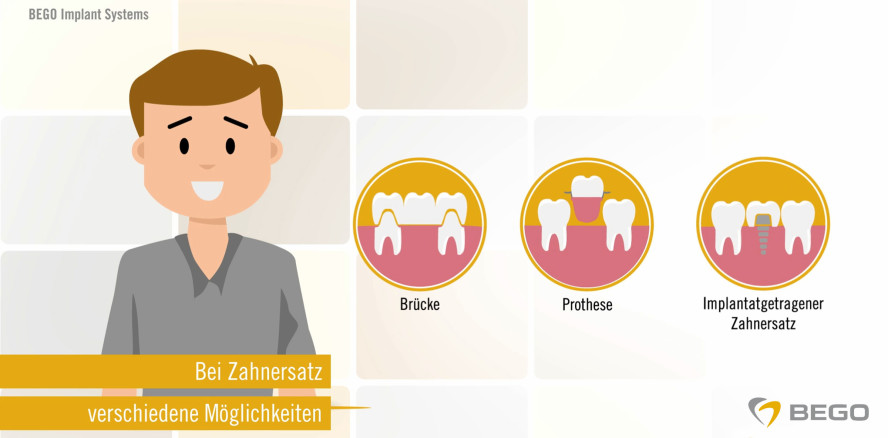 Was ist ein Zahnimplantat? Patientenfilm fürs Wartezimmer