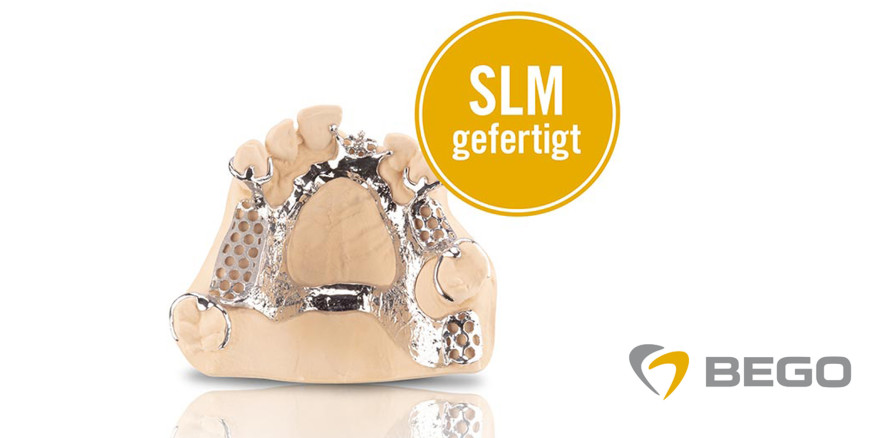 Digital gefertigte SLM-Modellgüsse für Ober- und Unterkiefer