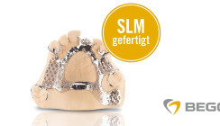 Digital gefertigte SLM-Modellgüsse für Ober- und Unterkiefer