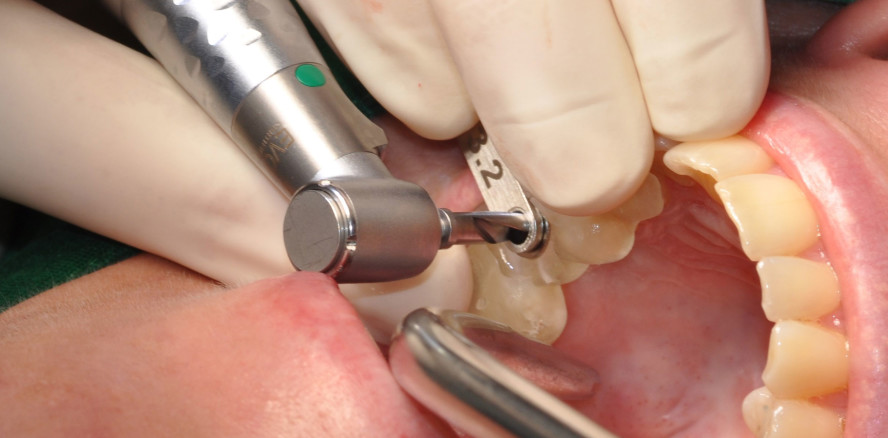 Schablonengeführte Sofortimplantation im Oberkiefer