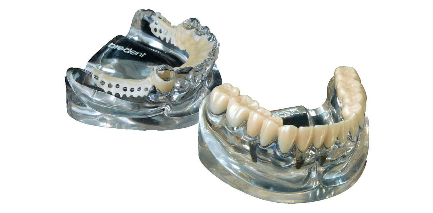 Ästhetische Funktionsschienen als Snap-on von bredent