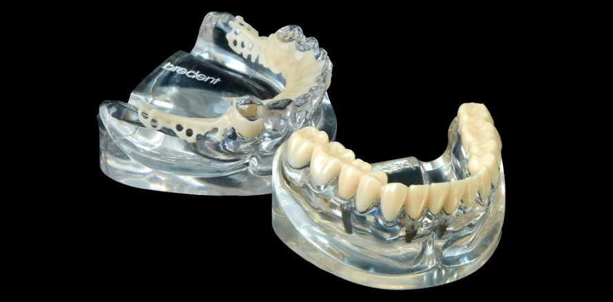 BioniCut Snap - Ästhetische Funktionsschienen als Snap-On