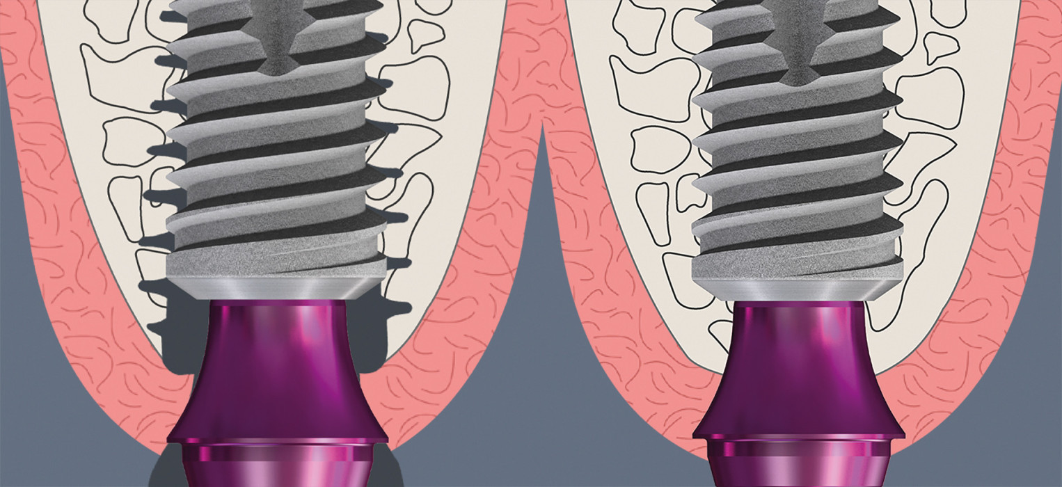 Verbesserte Osseointegration dank des Bone Growth Concepts