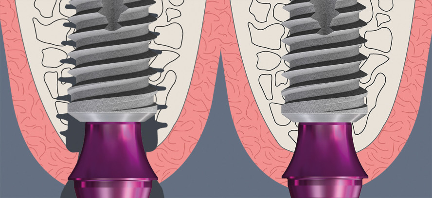 Verbesserte Osseointegration dank des Bone Growth Concepts