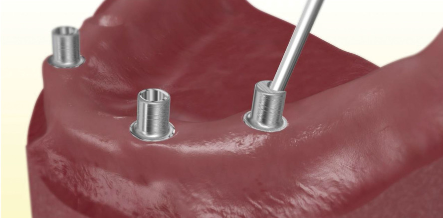 Herausnehmbare Brücke für alle Lebenssituationen