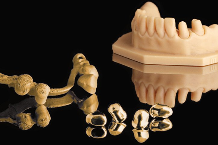 Teleskoptechnik All-in-One Verfahr­en als Chance für die Zahntechnik