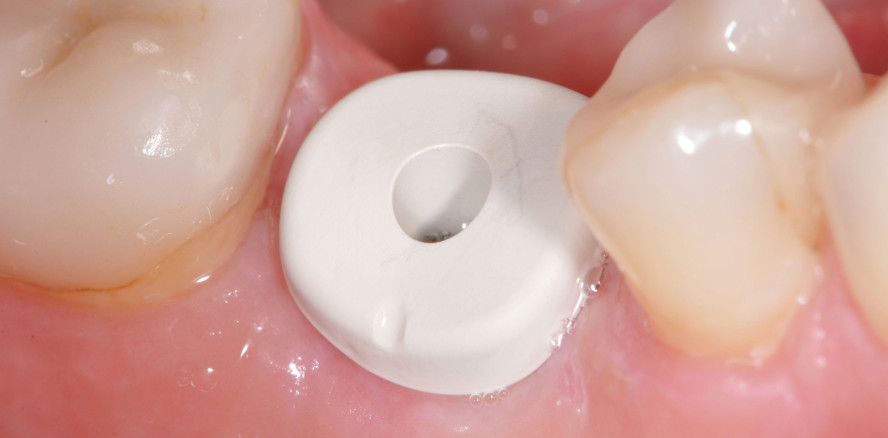 Individuelle PEEK-Gingivaformer und Abformpfosten