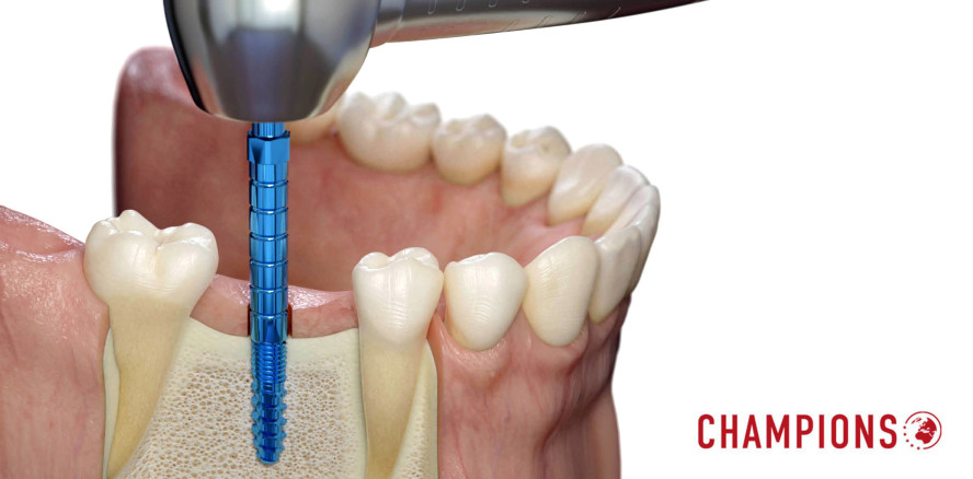 Knochen-Condenser zur Verdichtung von weichen Knochen