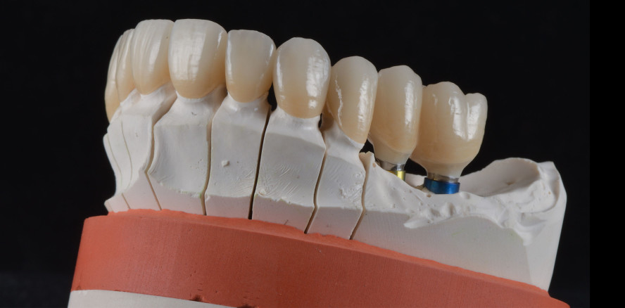 Präzise und sicher Abformen auch unter schwersten Bedingungen