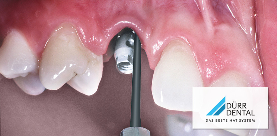 Schonend und effektiv gegen Parodontitis und Periimplantitis