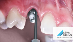 Schonend und effektiv gegen Parodontitis und Periimplantitis