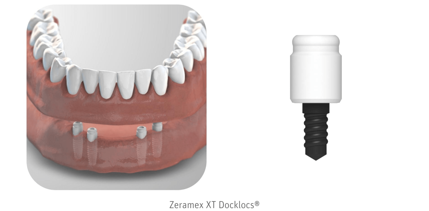Keramikimplantate: spannende und zukunftsträchtige Therapieoption