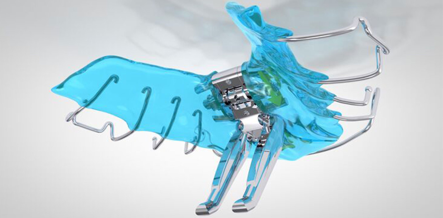 Effiziente Behandlung von Klasse II Fehlstellungen: Die Neo-VDP nach F. M. Sander*