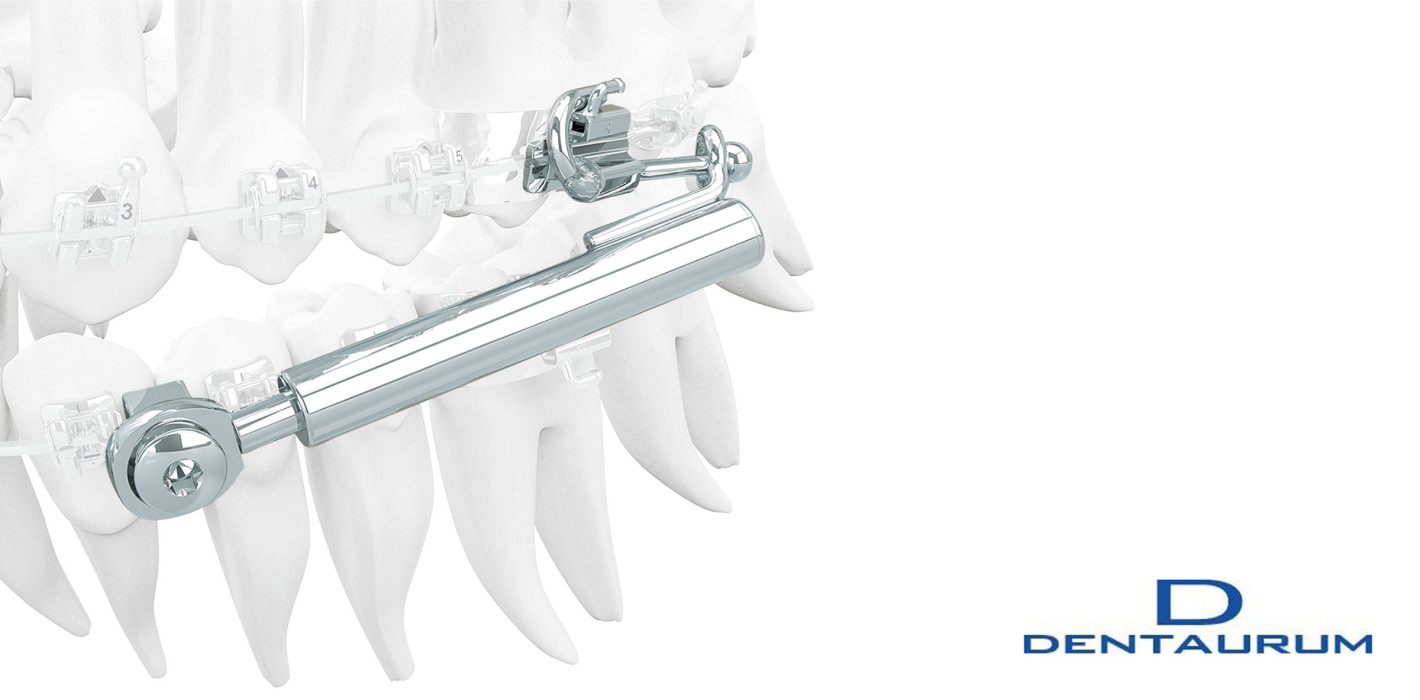 SUS³ – Sabbagh Universal Spring – die dritte Generation