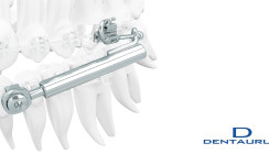 SUS³ – Sabbagh Universal Spring – die dritte Generation